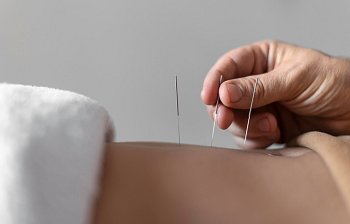 acupuncture