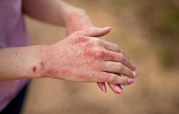 eczema