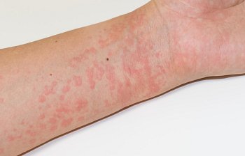nettle rash